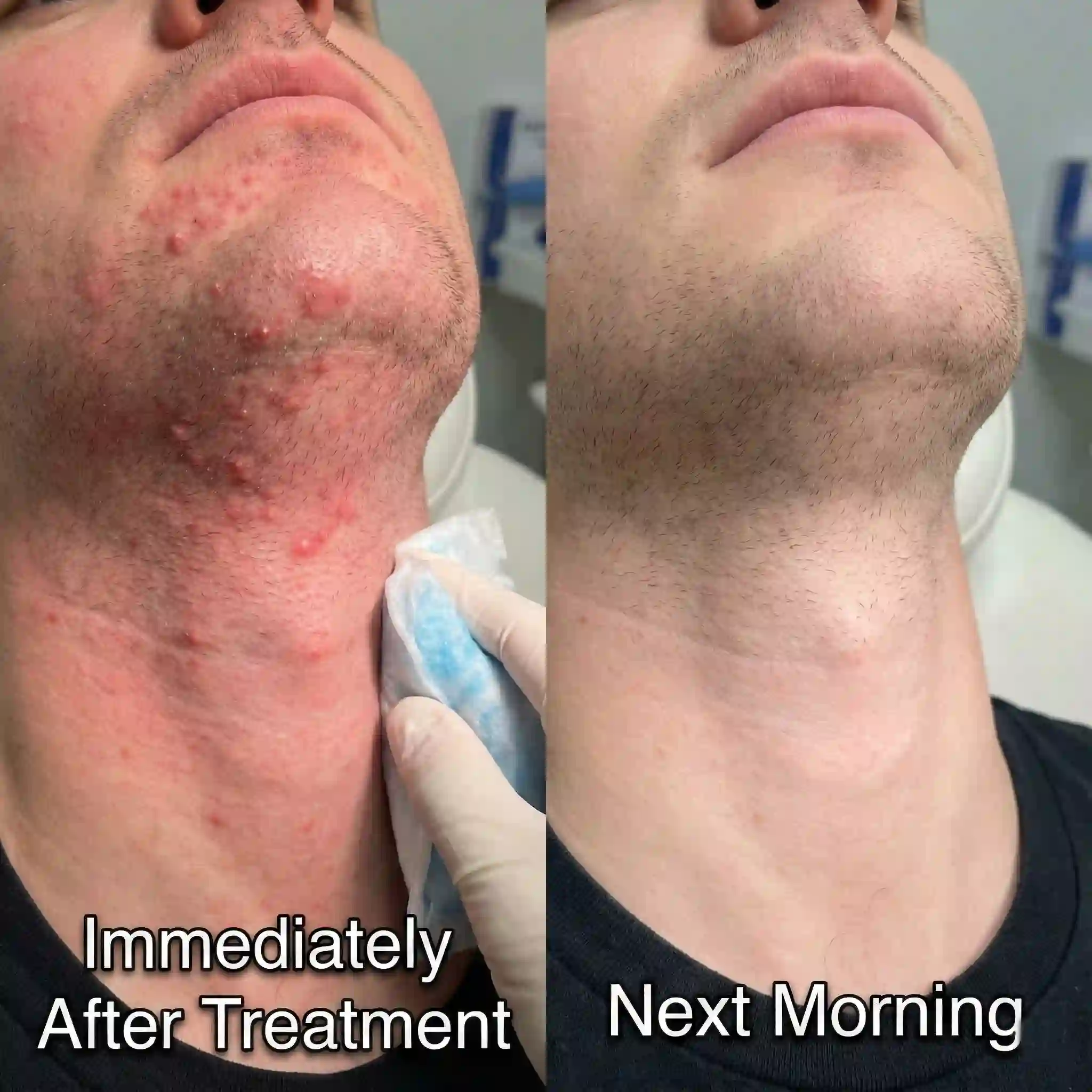 Man showing slight facial redness after beard removal laser, demonstrating normal post-session effects, cooling care, and realistic expectations between appointments while progressing toward permanent hair reduction over multiple treatments.