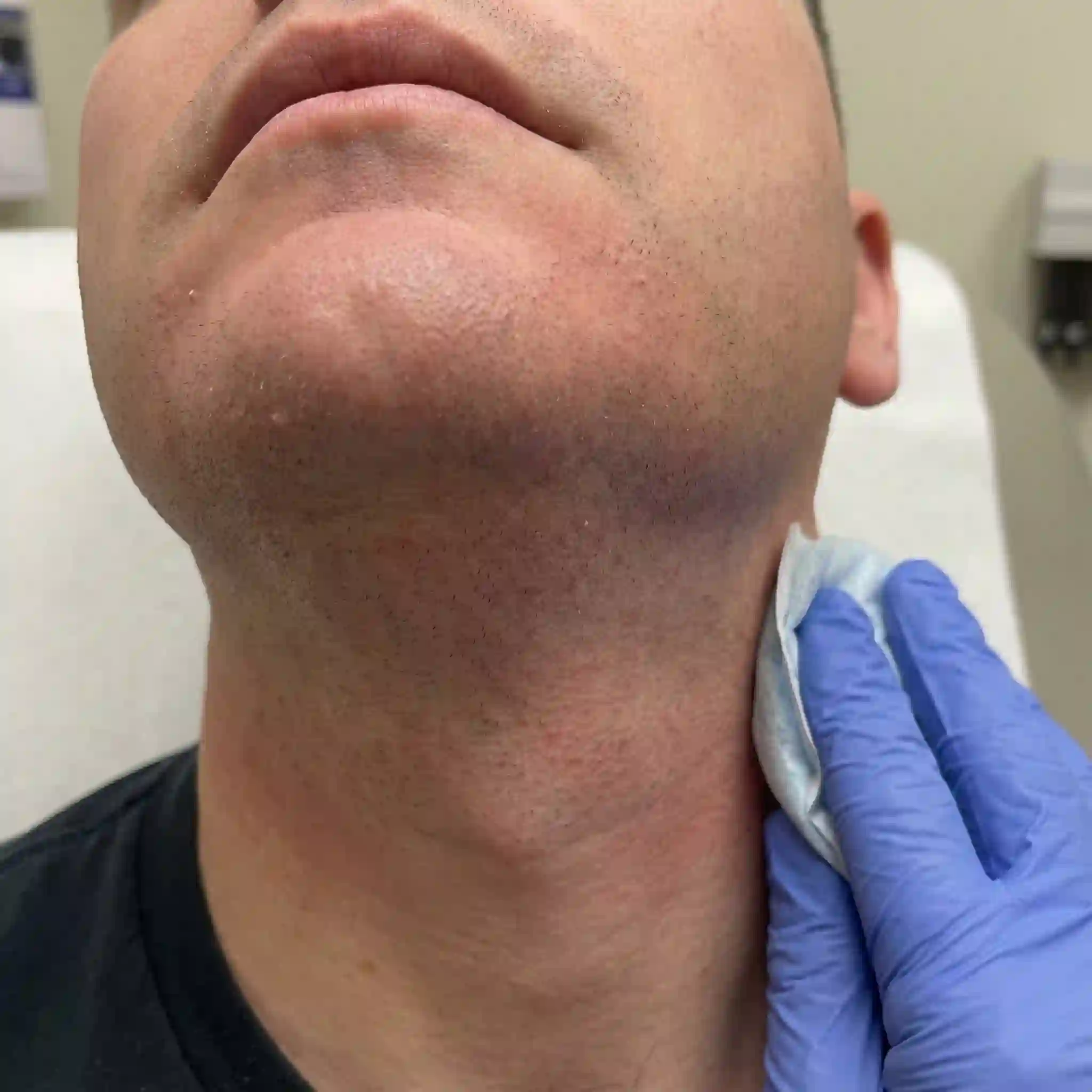 Close-up of post-treatment redness after beard removal laser, illustrating expected temporary skin response, aftercare recommendations, and typical recovery timeline before hair shedding and visible reduction appear in subsequent weeks.