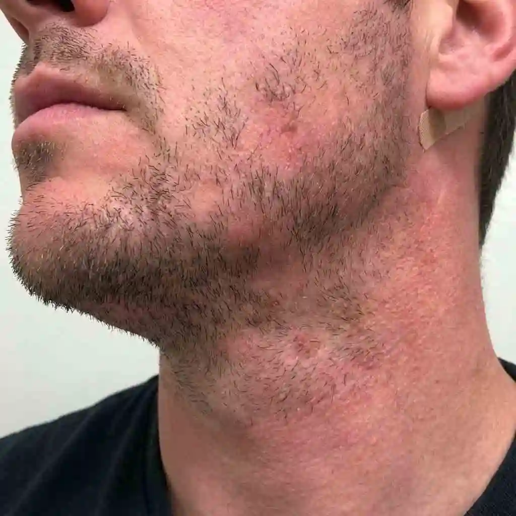 laser hair removal beard: Is The Cost Worth It?