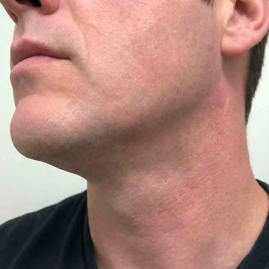 Real before and after photos demonstrating the effective results of a full laser hair removal beard treatment course, achieving an eighty to ninety percent permanent reduction in hair growth for a cleaner appearance.