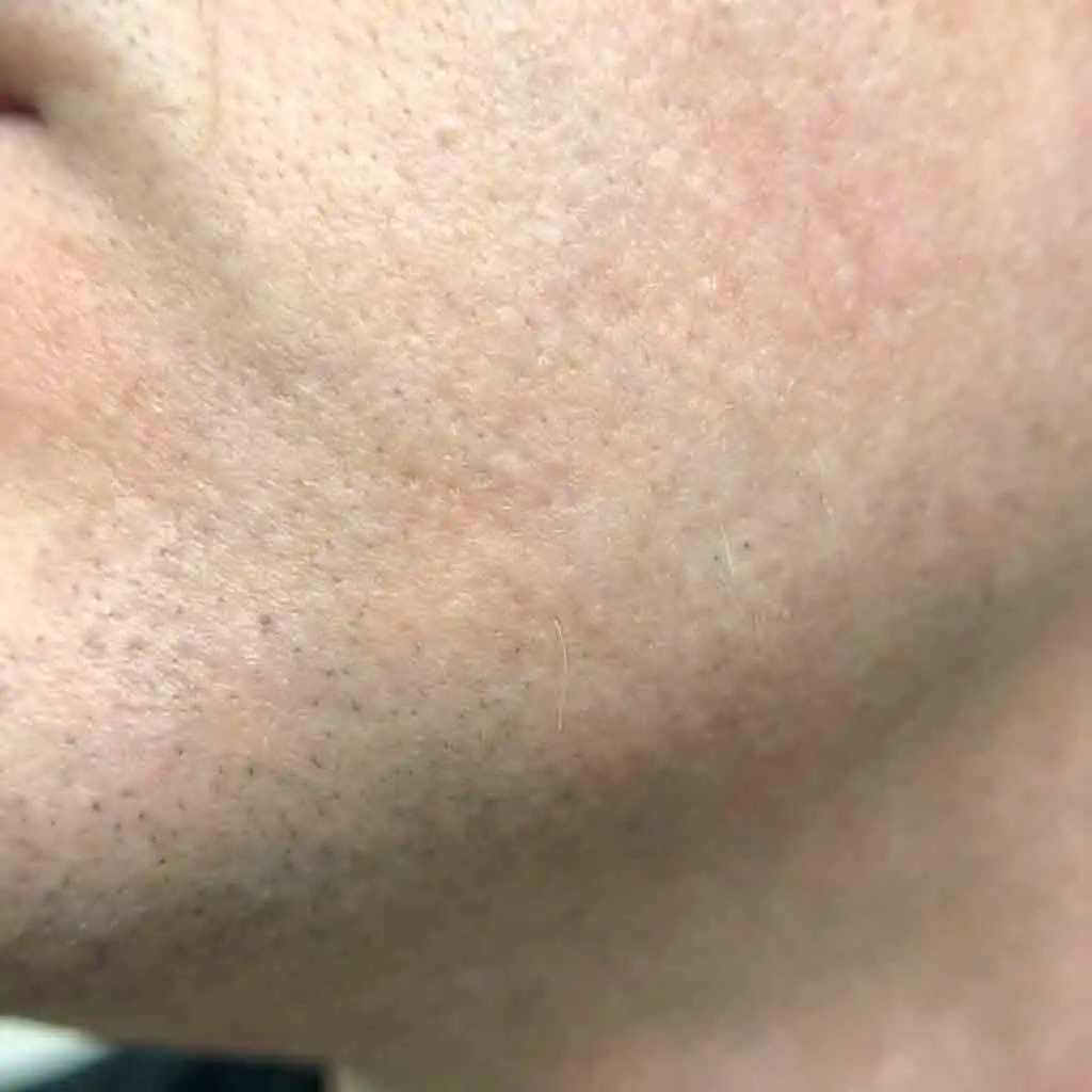 Graphic explaining the industry definition of permanent reduction in laser hair removal beard treatments, where the vast majority of coarse dark hair is destroyed, leaving only fine and unnoticeable hairs on the face.