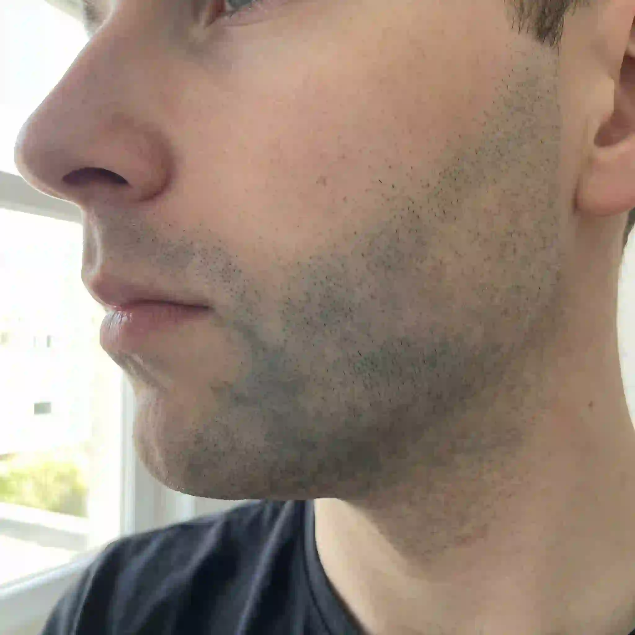 Comparison showing the difference between a clean shave with a razor entailing beard shadow and the result of using a beard removal cream which dissolves hair below the skin surface, eliminating dark hair follicles.