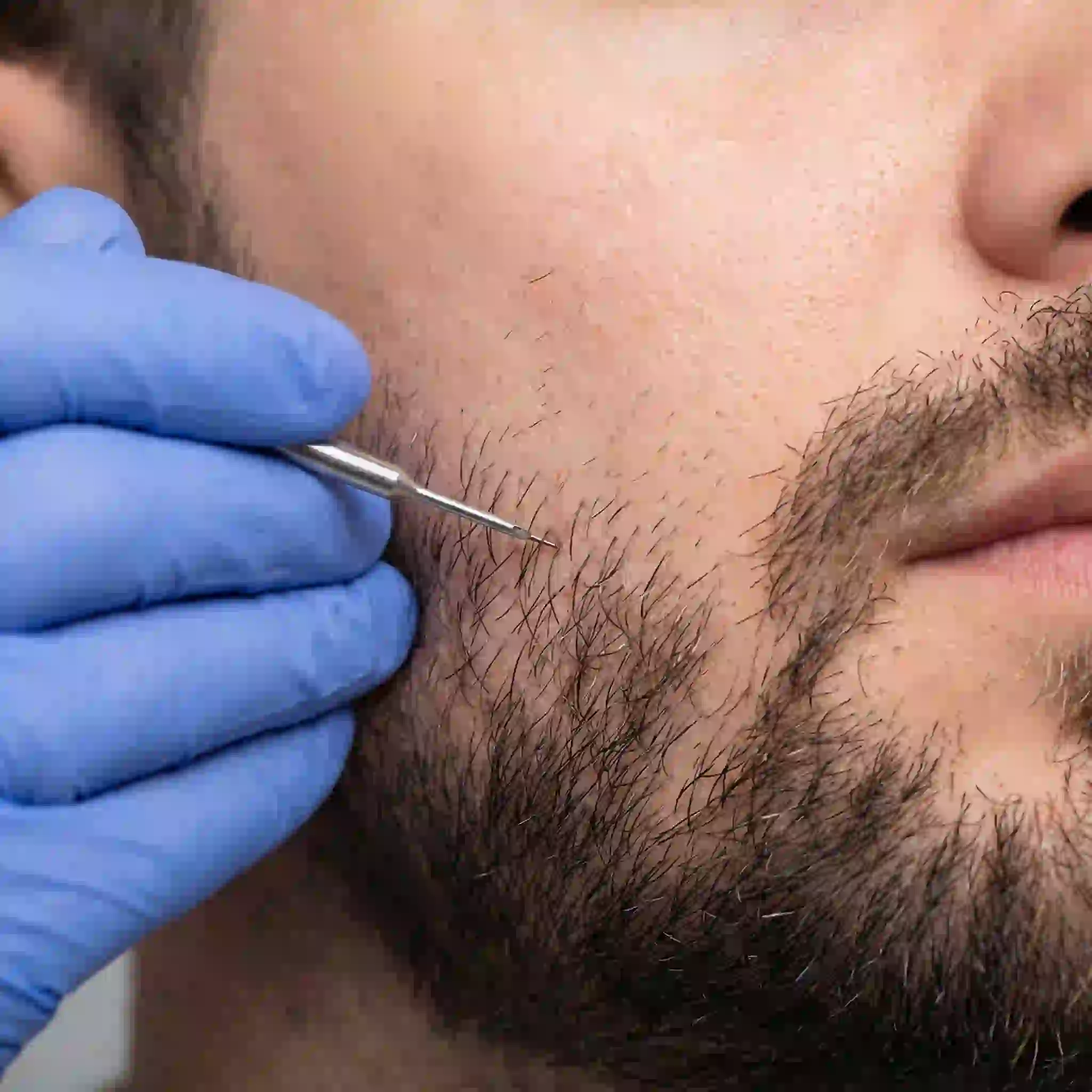 Permanent Beard Removal: The 2026 Ultimate Guide