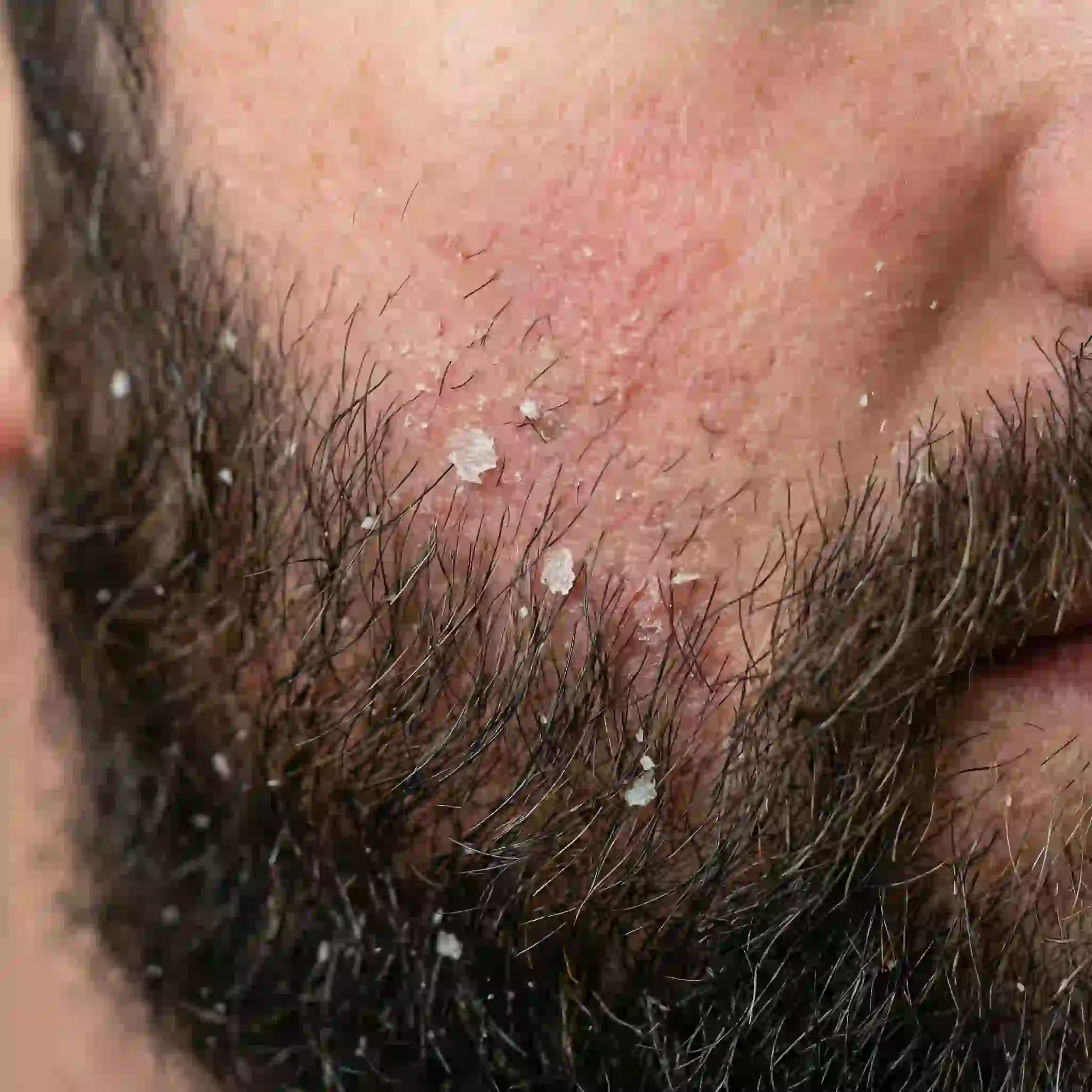 beard dandruff shampoo routine explaining how excess oil and Malassezia buildup can trigger flakes, redness, and itch beneath a thick beard