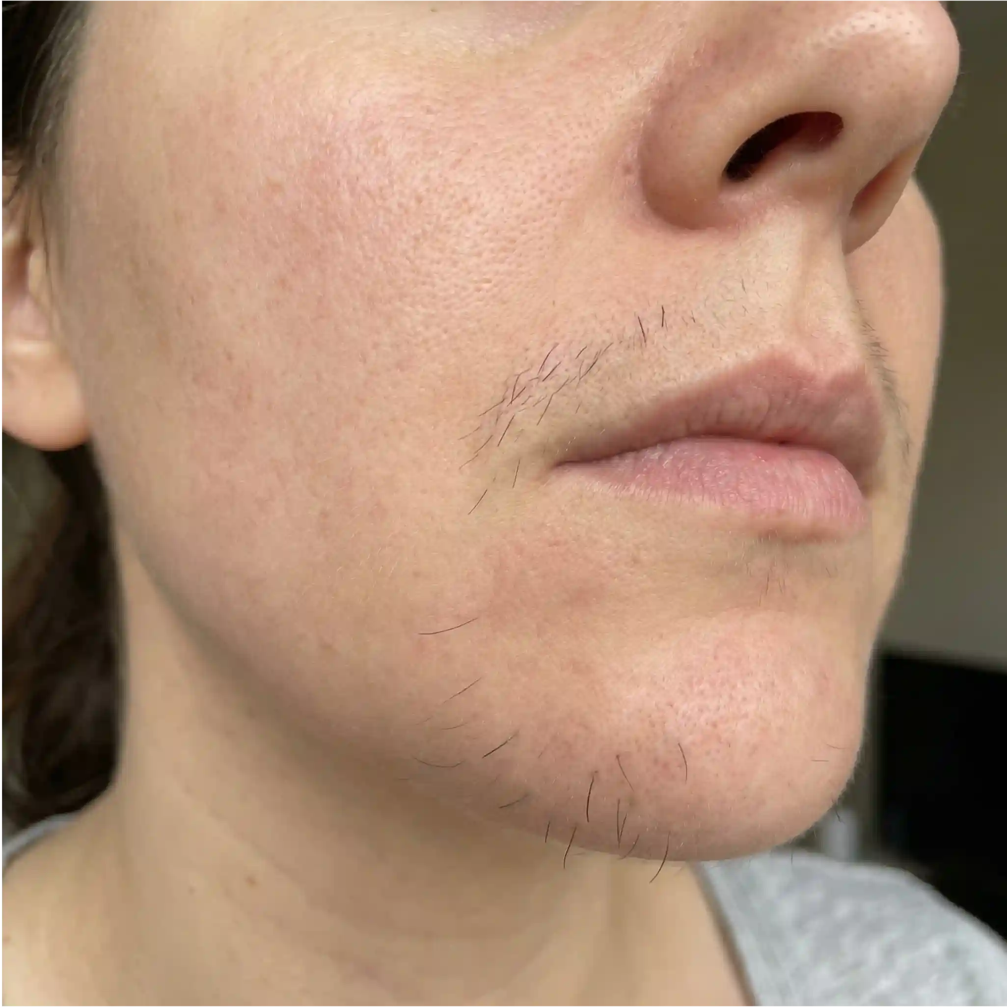 facial hair removal women comparison showing darker terminal hair on the chin, upper lip, and sideburns that may require stronger long-term methods.